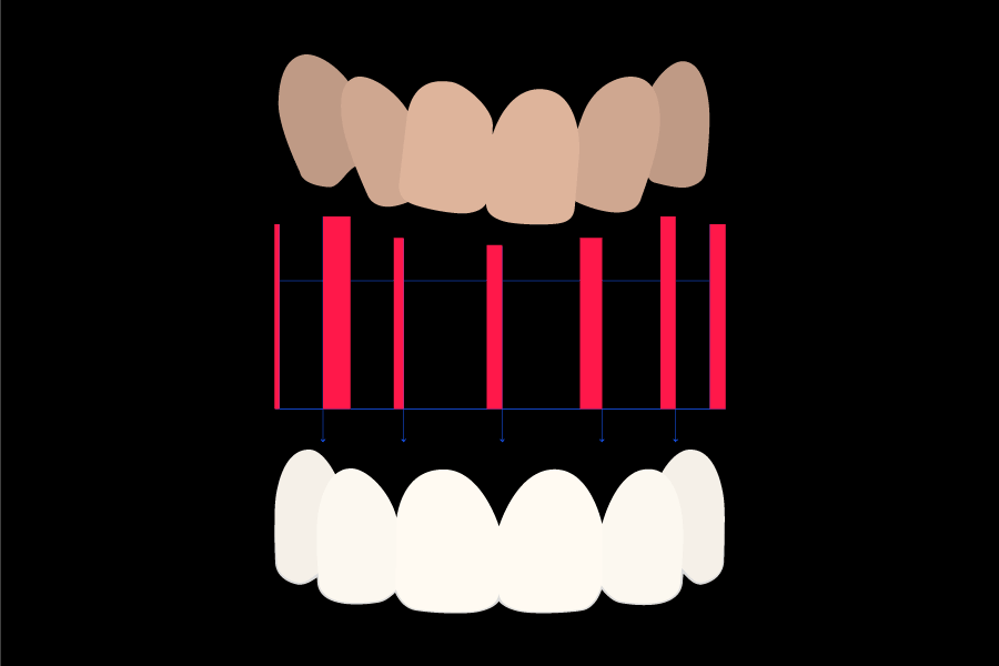 dental crowding treatment with veneers
